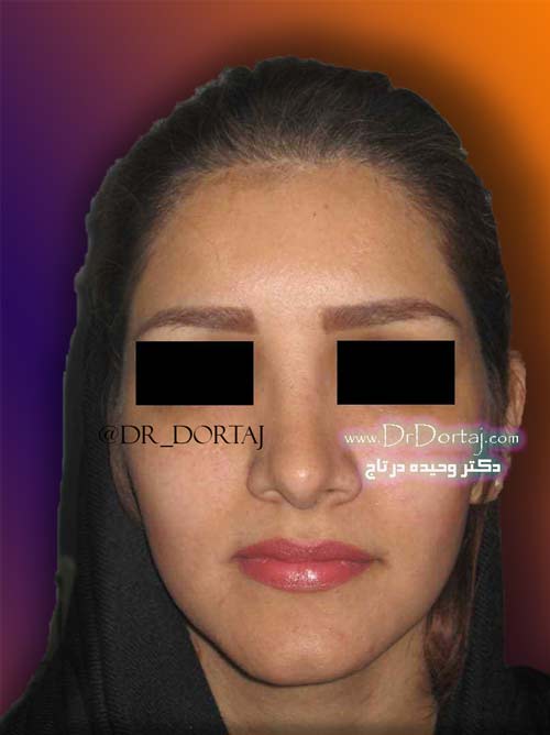 قبل و بعد از عمل بینی گوشتی