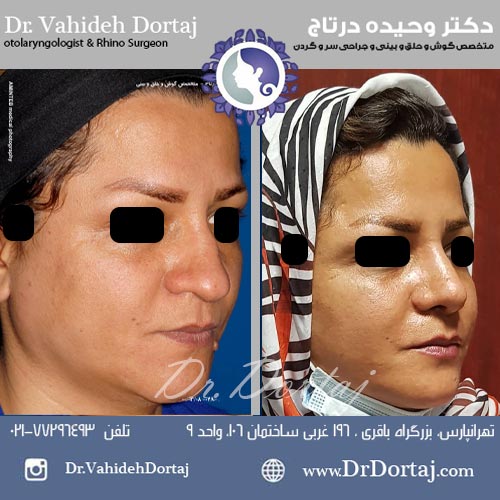 قبل و بعد از عمل بینی گوشتی و کج