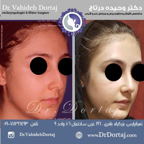 قبل و بعد از عمل بینی به شکل طبیعی